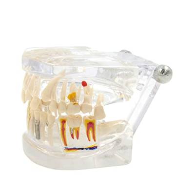 Transparentes Implantatmodell, abnehmbare Zähne, tragbares Zahnmodell für Zahnarzt-Vorlesungsausbildung, Verwendung Implantatzähne, Implantatzahnmodell von KASFDBMO