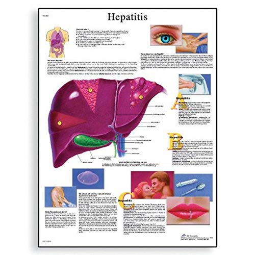 3B Scientific Human Anatomy – Hepatitis-Diagramm, Papierversion von 3B Scientific