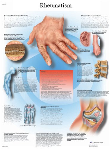 3B Scientific Human Anatomy - Rheumatische Erkrankungen, laminierte Version von 3B Scientific