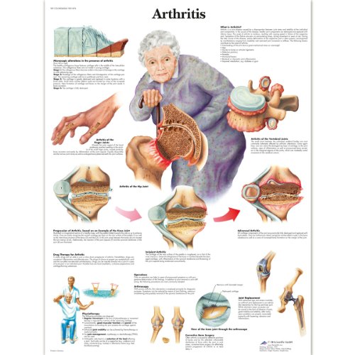 3B Scientific Humananatomie – Arthritis-Diagramm, laminierte Version von 3B Scientific