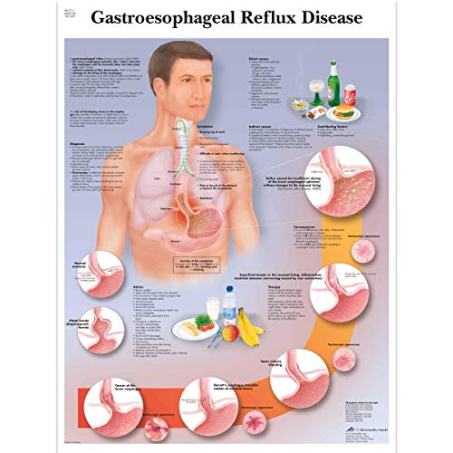 3B Scientific Humananatomie – Gastroesophageale Reflux-Krankheit, laminierte Version 3B Scientific Humananatomie – Gastroesophageale Reflux-Krankheit, laminierte Version von 3B Scientific
