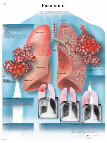 3B Scientific Humananatomie – Lungenentzündung, laminierte Version von 3B Scientific