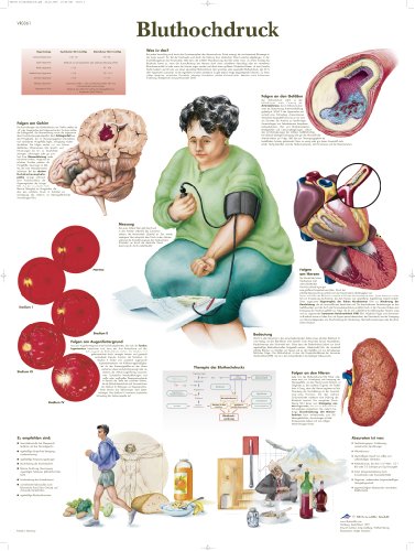 3B Scientific Lehrtafel - Bluthochdruck von 3B Scientific