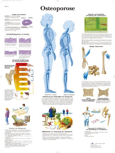 3B Scientific Lehrtafel laminiert - Osteoporose, VR0121L von 3B Scientific
