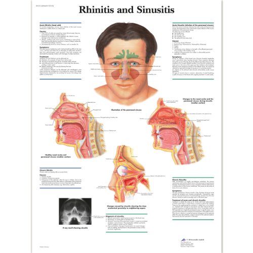 3B Scientific Lehrtaffel laminiert - Rhinitis and Sinusitis - Englisch von 3B Scientific