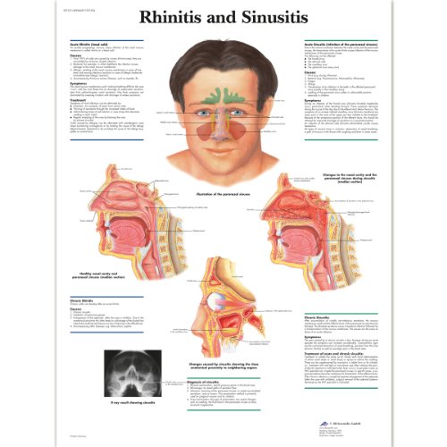 3B Scientific Lehrtaffel laminiert - Rhinitis and Sinusitis - Englisch 3B Scientific Lehrtaffel laminiert - Rhinitis and Sinusitis - Englisch von 3B Scientific