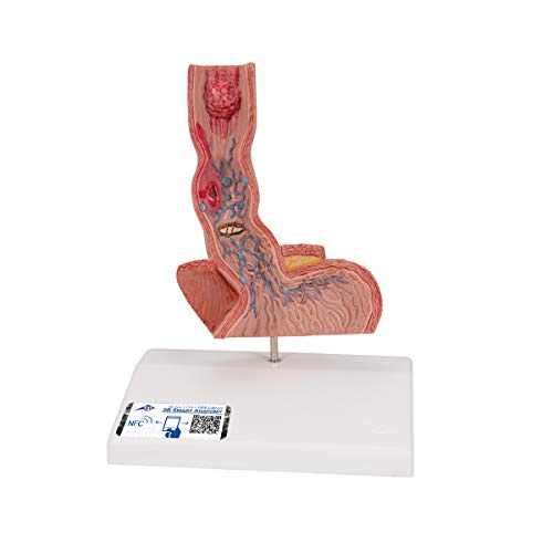 3B Scientific Menschliche Anatomie - Erkrankungen der Speiseröhre + kostenlose Anatomie App - 3B Smart Anatomy 3B Scientific Menschliche Anatomie - Erkrankungen der Speiseröhre + kostenlose Anatomie App - 3B Smart Anatomy von 3B Scientific