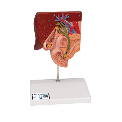 3B Scientific Menschliche Anatomie - Gallensteinmodell + kostenlose Anatomie App - 3B Smart Anatomy von 3B Scientific