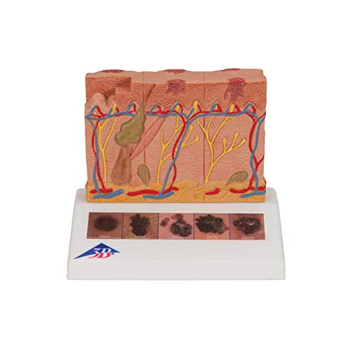 3B Scientific Menschliche Anatomie - Hautkrebs-Modell + kostenlose Anatomie App - 3B Smart Anatomy, J15 von 3B Scientific