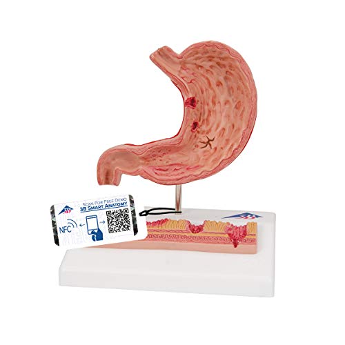 3B Scientific Menschliche Anatomie - Magen mit Magengeschwüren + kostenlose Anatomie App - 3B Smart Anatomy 3B Scientific Menschliche Anatomie - Magen mit Magengeschwüren + kostenlose Anatomie App - 3B Smart Anatomy von 3B Scientific