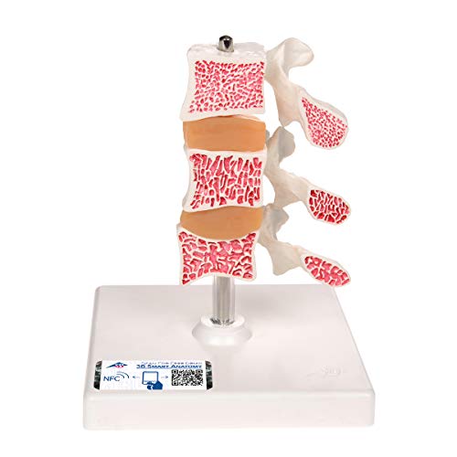 3B Scientific Menschliche Anatomie - Osteoporose Modell mit 3 Lendenwirbeln, auf Stativ + kostenlose Anatomie App - 3B Smart Anatomy, Luxusmodell von 3B Scientific