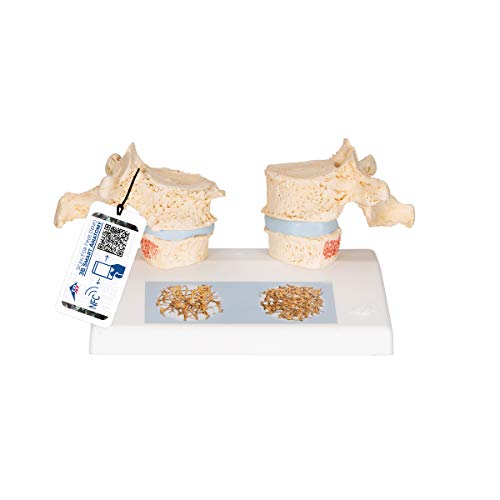 3B Scientific Menschliche Anatomie - Osteoporosemodell + kostenlose Anatomie App - 3B Smart Anatomy 3B Scientific Menschliche Anatomie - Osteoporosemodell + kostenlose Anatomie App - 3B Smart Anatomy von 3B Scientific