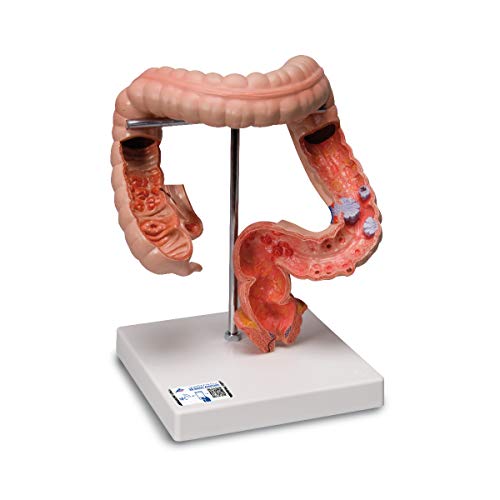 3B Scientific Menschliche Anatomie - Pathologisches Darmmodell (Dick- und Enddarm) + kostenlose Anatomie App - 3B Smart Anatomy, K55 von 3B Scientific