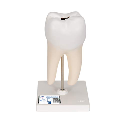3B Scientific Menschliche Anatomie - Unterer zweiwurzeliger Molar mit Karies, 2-teilig + kostenlose Anatomie App - 3B Smart Anatomy 3B Scientific Menschliche Anatomie - Unterer zweiwurzeliger Molar mit Karies, 2-teilig + kostenlose Anatomie App - 3B Smart Anatomy von 3B Scientific