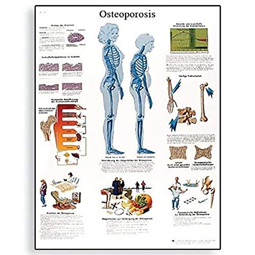 3B Scientific Osteoporose Schaubild, unlaminated von 3B Scientific