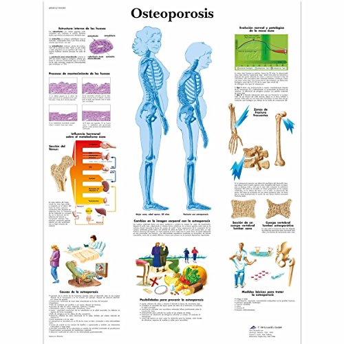 3B Scientific Papier bedruckt, Osteoporose, 1 von 3B Scientific