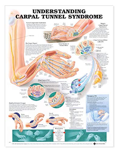 Understanding Carpal Tunnel Syndrome Anatomical Chart von Anatomy Stuff