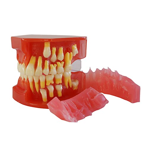 Abnehmbares Zahnmodell Zahnwiederherstellungsbehandlung Lehrmittel Implantatstudie Analyse Demonstrationszahnmodell Abnehmbares Zahnmodell Zahnwiederherstellungsbehandlung Demonstrationsmodell von BAYORE
