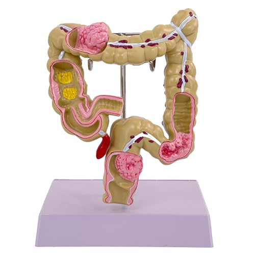 Humane Pathologien Des Großen Darmmodells Menschliches Großdarmmodell Menschliches Anatomisches Modellmediziner Unterrichten Hilfe von Cnrfeoap