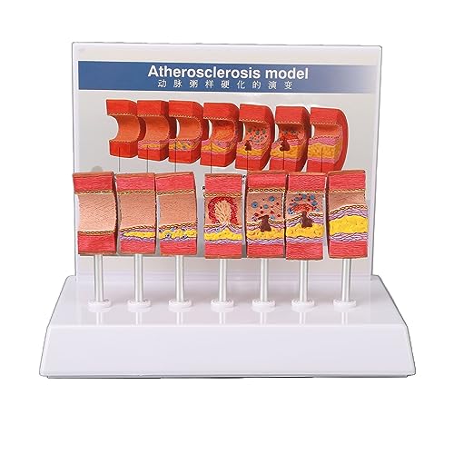 7 -teiliges Arterien -Anatomie -Modell, anatomischer Atherosklerose Thrombus Gefäßreplik, Instrument für klinische Ausbildung für Arztpraxis von DIRBAK