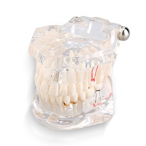 Zahnmodell Tutorial Kiefer für Zahnärzte Zahnkrankheiten Lehre Studie Erwachsener Typodont Demonstrationszähne Modell Neu von Dioche