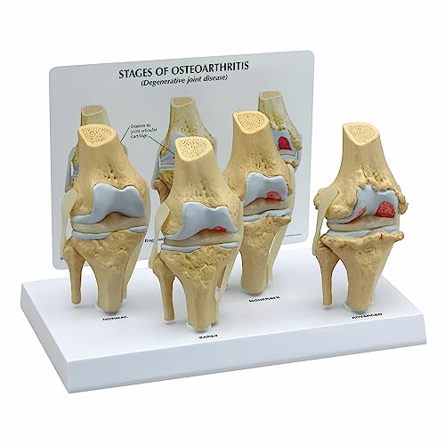 GPI Anatomicals 1100 Osteo-Kniemodellset 4 verschiedener Stadien von 3B Scientific