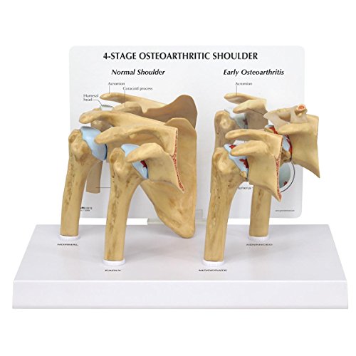 GPI Anatomicals 1800 Schuler Modell, Arthrose 4 Stadien GPI Anatomicals 1800 Schuler Modell, Arthrose 4 Stadien von 3B Scientific
