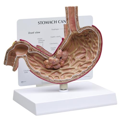 GPI Anatomicals 2001 Magenkrebs Modell GPI Anatomicals 2001 Magenkrebs Modell von 3B Scientific