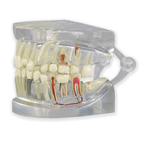 GPI Anatomicals 2861 Gebiss Modell durchsichtig mit Zähnen GPI Anatomicals 2861 Gebiss Modell durchsichtig mit Zähnen von 3B Scientific