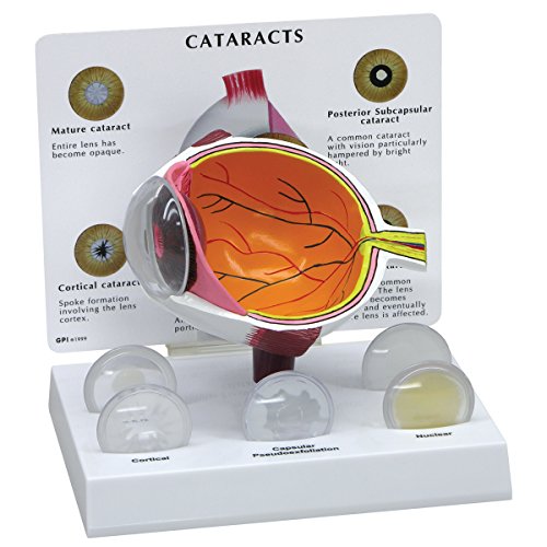 GPI Anatomicals W47852 Auge Modell Katarakt, grauer Star von 3B Scientific