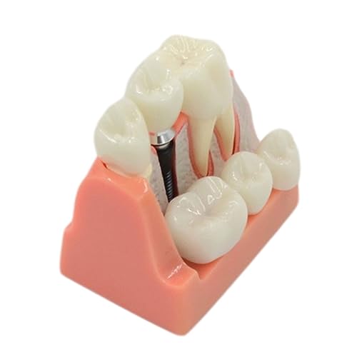 Zahnmodell, 4-faches Implantatmodell für Zahnarzt, Studenten, Demonstrationsmodul, Unterricht, Studium, Wissenschaftsmodelle für Patientenbildung, Studenten, Lehrforschung von KASFDBMO