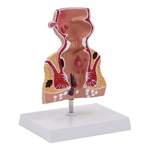 Human Pathologies of Rectum Model Human Rectum Model Human Anatomical Model Medicals Teaching Tool for Teaching Human Pathologies of Rectum Model Human Rectum Model Human Anatomical Model Medicals Teaching Tool for Teaching von LLHCF