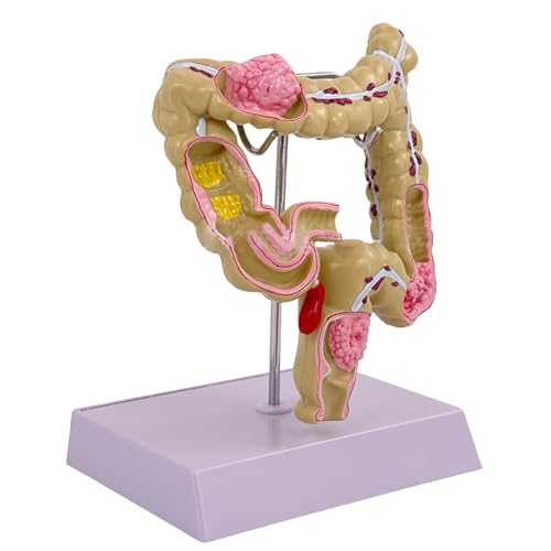 Humane Pathologien Des Großen Darmmodells Menschliches Großdarmmodell Menschliches Anatomisches Modellmediziner Unterrichten Hilfe Humane Pathologien Des Großen Darmmodells Menschliches Großdarmmodell Menschliches Anatomisches Modellmediziner Unterrichten Hilfe von Limtula
