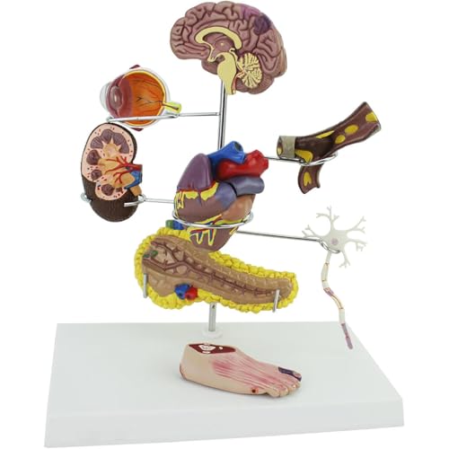 Diabetes Model Set, Human Diabetic Pathology Model, 8 Komponenten, Fuß-Gehirn-Herz-Nierenthrombose-Modell, Diabetes Und Komplikationen Display, Für Arzt-Patienten-Kommunikation Diabetes Model Set, Human Diabetic Pathology Model, 8 Komponenten, Fuß-Gehirn-Herz-Nierenthrombose-Modell, Diabetes Und Komplikationen Display, Für Arzt-Patienten-Kommunikation von Mavdecll