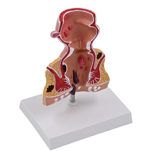 Human Pathologies of Rectum Model Human Rectum Model Human Anatomical Model Medicals Teaching Tool for Teaching Human Pathologies of Rectum Model Human Rectum Model Human Anatomical Model Medicals Teaching Tool for Teaching von Qsvbeeqj