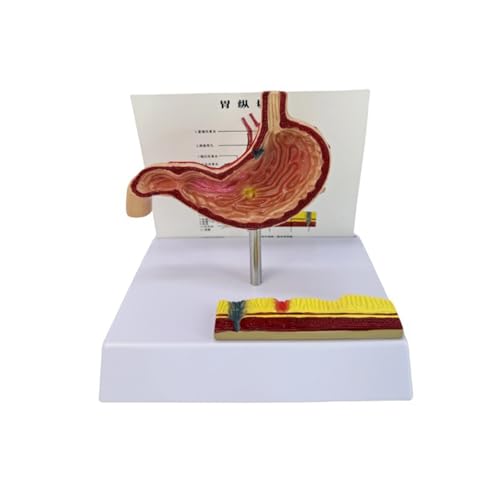 Menschlicher Magenanatomie Modell Anatomischer Magenperforationsmodell Pathologischer Magenanatomie Modell Unterrichtswerkzeug von Qsvbeeqj