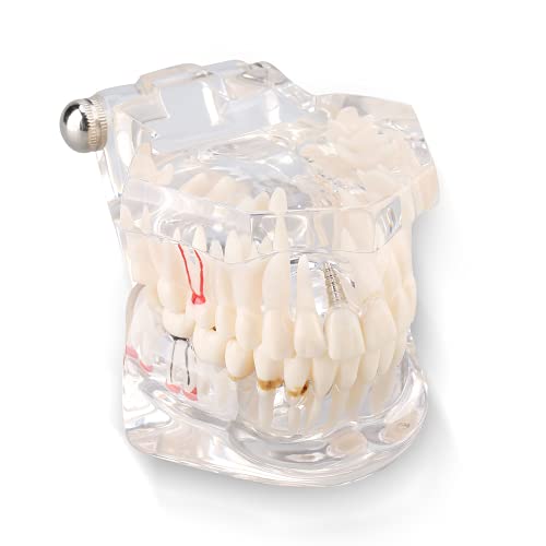 Lehrmodell für Zahnkrankheiten, Demonstrationsmodell, Zahnmodell, festes prothetisches Implantat für zahnmedizinische Schulen von TOPINCN