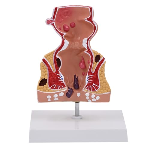 Humanes Anatomisches Modell Menschliches Rektum Modell Humaner Pathologien Des Rektummodellunterrichts Hilfe Für Die Wissenschaftliche Bildung von Woedpez