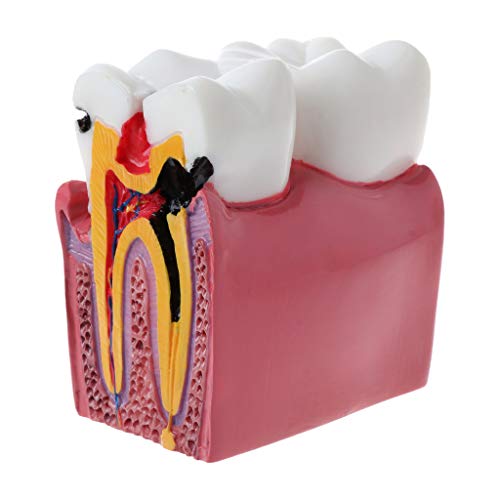 6 Karies Vergleichszähne Modell für Dentallabor Tee von X-Institute