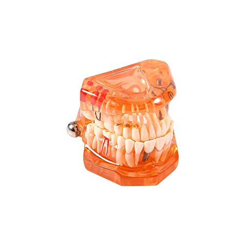 Dental Zähne Herausnehmbar Zahnmodell Zahnprotesen Demonstration Zähne Modell für Studie Lehren (Orange) von Yosoo