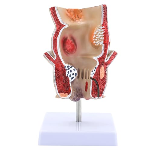 Human Pathologies of Rectum Model Human Rectum Model Human Anatomical Model Medicals Teaching Tool for Teaching Human Pathologies of Rectum Model Human Rectum Model Human Anatomical Model Medicals Teaching Tool for Teaching von Zqxnt